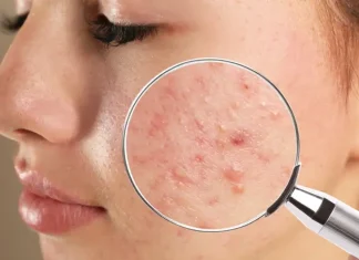 Oleosidade da pele, cravos e acne: como tratar?